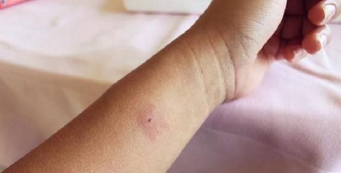 6 típusú rovarcsípés, amivel te is találkozhatsz idén nyáron (így kezeld ezeket)!