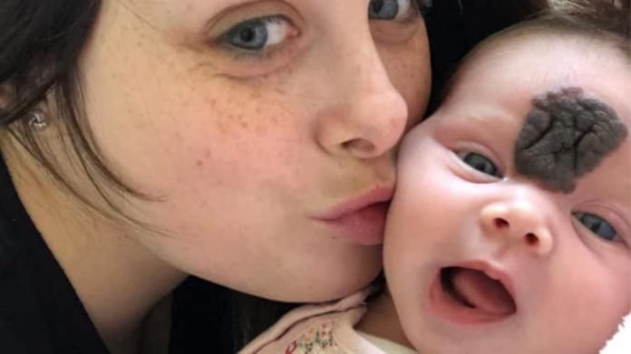 Hatalmas anyajeggyel a homlokán született a kisbaba - ez volt az orvosok reakciója