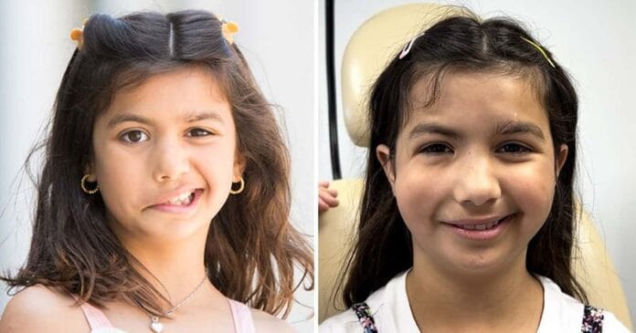 Nicole A 11 éves lány mindent megváltoztató műtéten esett át, hogy mosolyogni tudjon