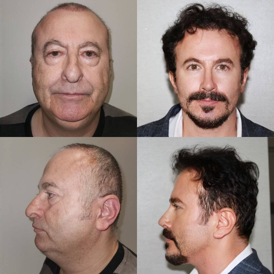 Plasztikai műtét előtte utána kép